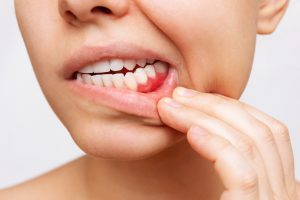 Gum disease, inflammation, dental health coach